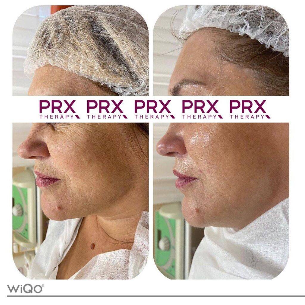 PRX33 Behandeling voor en na