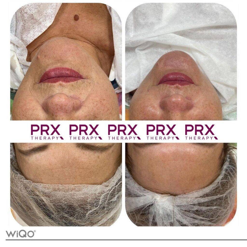 PRX33 Behandeling voor en na